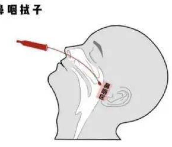天津核酸检测是咽拭子还是鼻拭子（天津核酸检测是咽拭子吗）