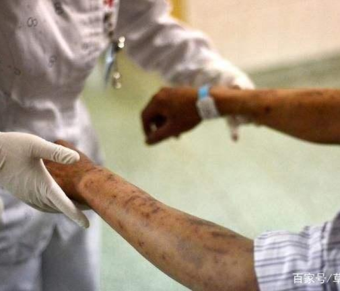 HIV0号病人:HIV0号病人