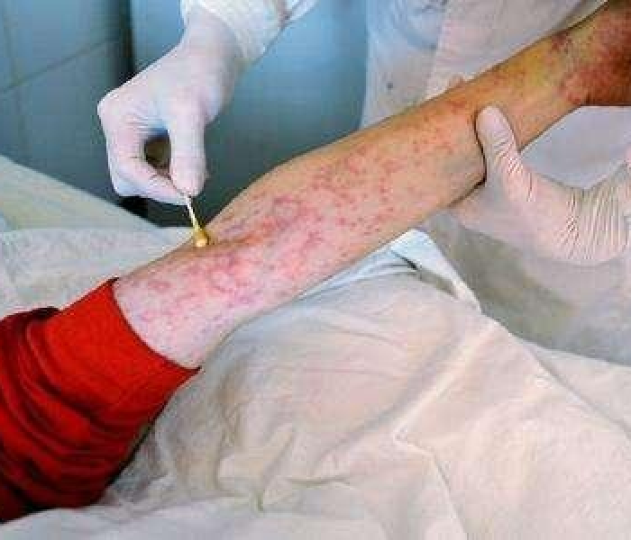 HIV0号病人:HIV0号病人