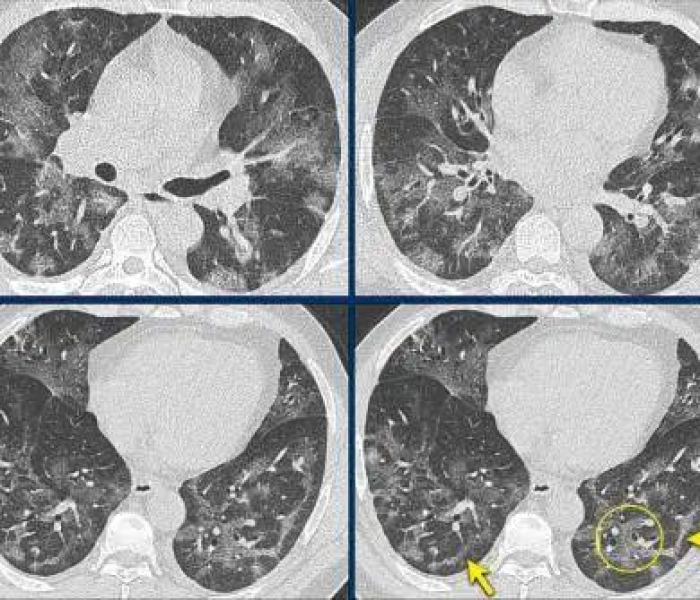 江苏无锡新型冠状病毒最新消息/江苏无锡新型冠状病毒最新消息新闻