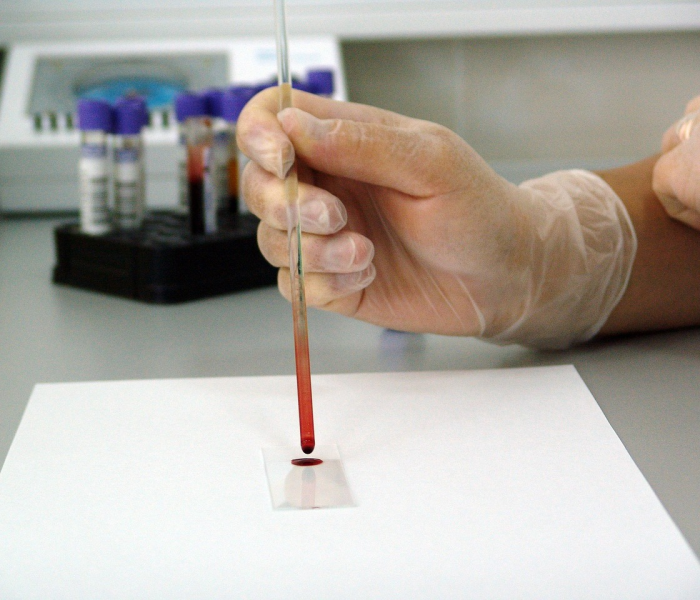 【南非有多少艾滋病人/南非有多少艾滋病人口】